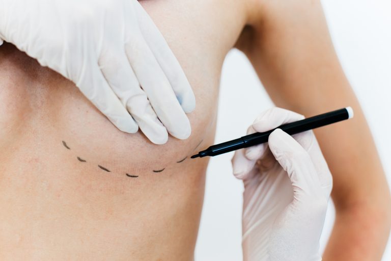 Médico faz marcação de cirurgia na mama de uma mulher